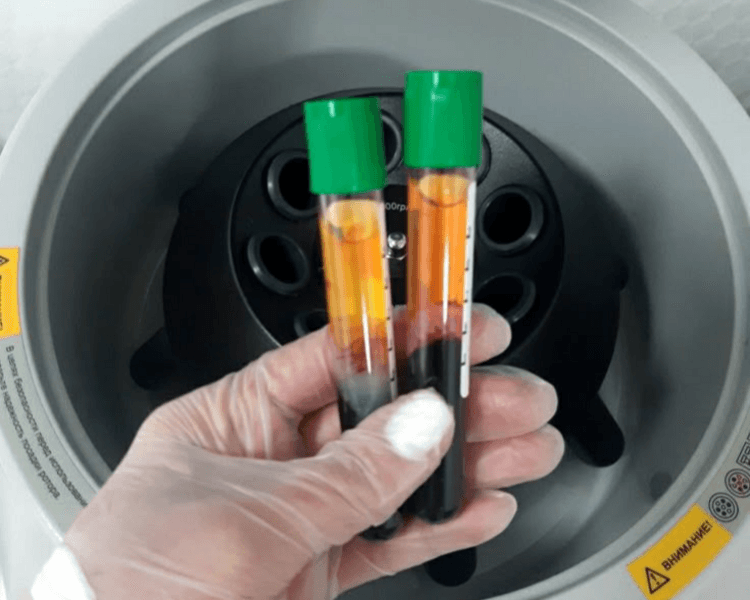 Plasma Rico en Plaquetas Capilar