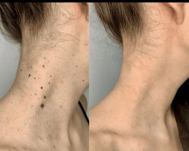 Extracción de 1 acrocordon grande + 10 pequeños