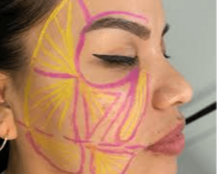 Adipoestructuración Facial + Papada (1sesión)