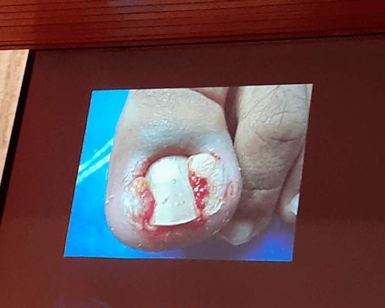 Atención de Uña Encarnada Bilateral