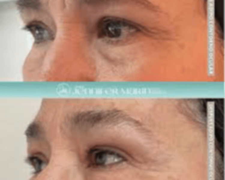 Adipoestructuración Contorno Ocular (1sesión)