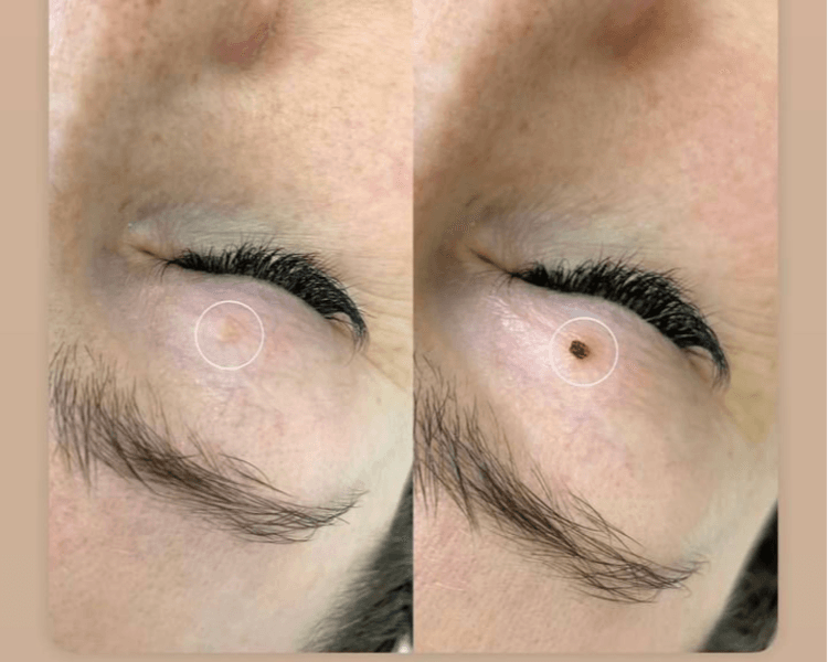 Cauterización de lunares x3