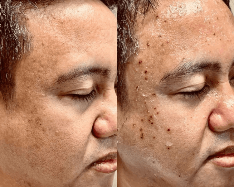 Cauterización de lunares x10