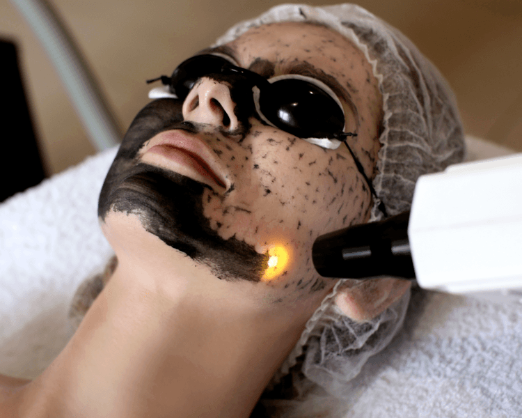 Hollywood Peel + Exosomas 2 sesiones 💆🏽♂️🧬💎