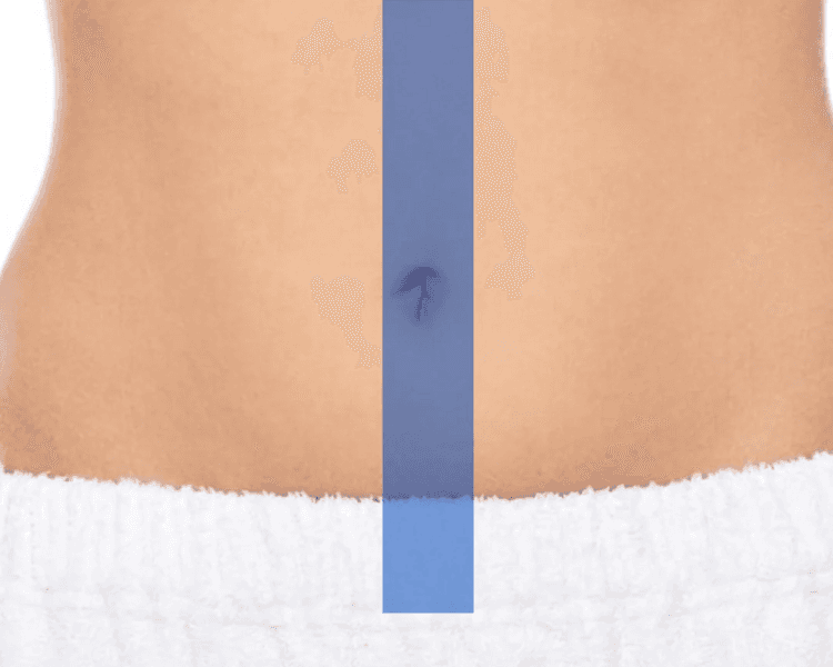 DEPILACION LÁSER LÍNEA ALBA