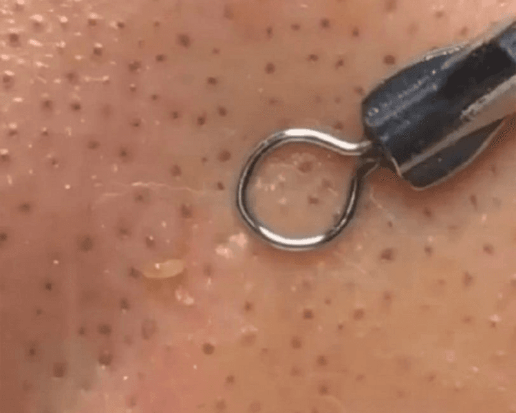 EXTRACCION DE COMEDONES (PUNTOS NEGROS)