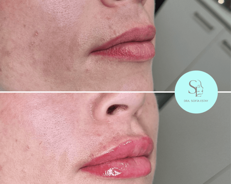 Aumento y perfilado de labios