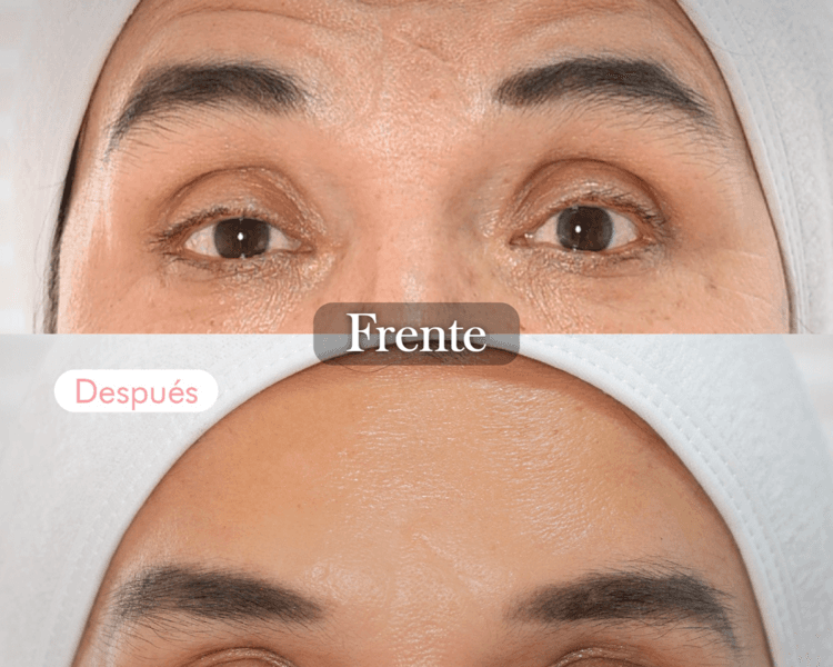 CONSULTA Toxina botulínica