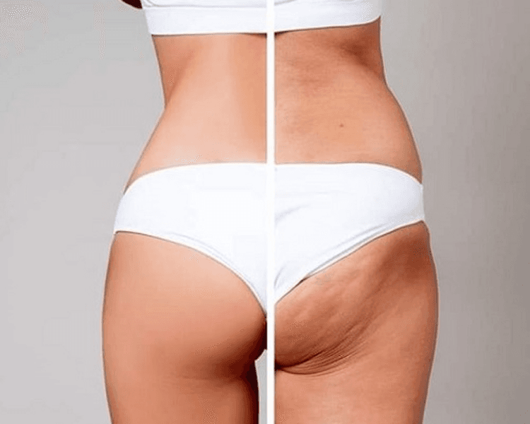 *Consulta Gratis* Tto. de *Celulitis*