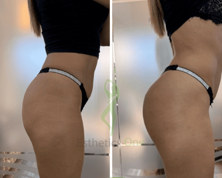 *Consulta Gratis* Tto. de *Glúteos*