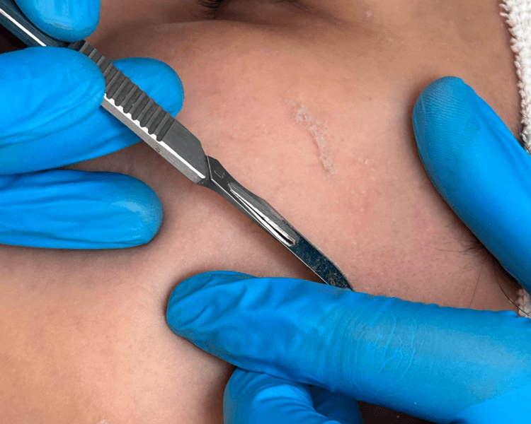Dermaplaning (Peeling con bisturí)
