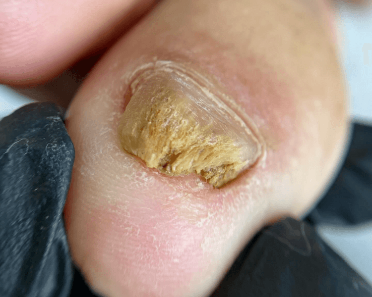 Pedicura Preventiva - Onicomicosis