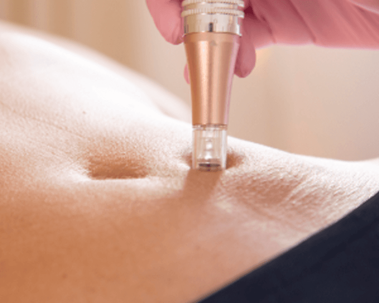 Eliminación de estrías