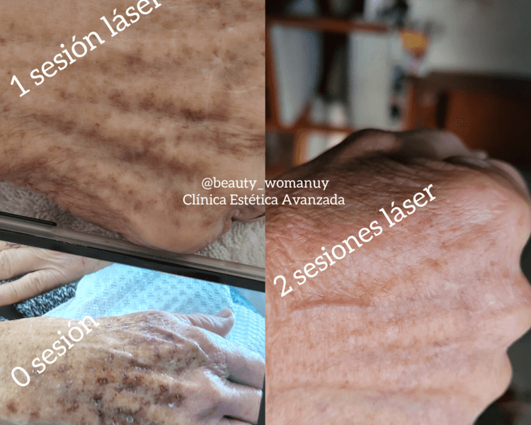 Tratamiento láser para MANCHAS DE LA EDAD, SOLARES, PECAS, ( en manos, escote, rostro o espalda ) 🟤