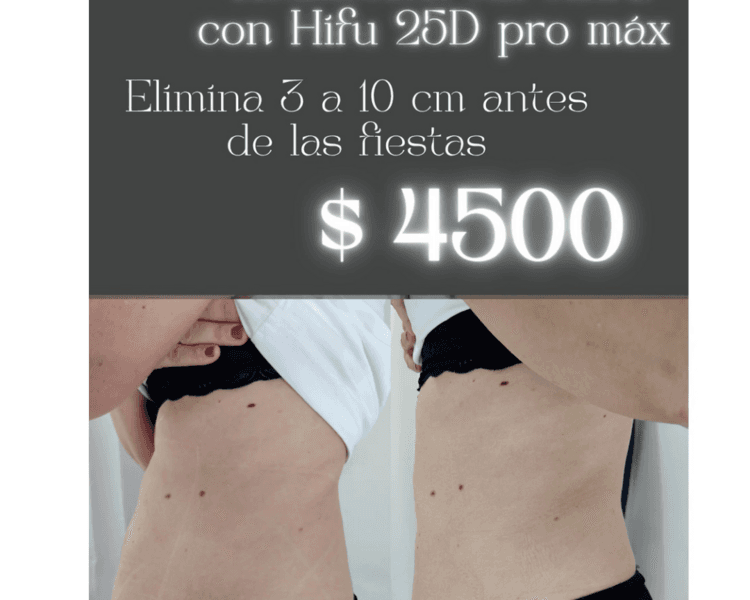 Tratamiento Hifu 25D pro máx, en zona Abdomen + 4 sesiónes intensivas con Emsculpt ( promo por tiempo limitado ) 💥