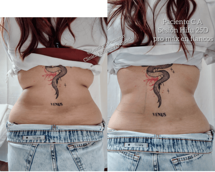 Tratamiento Hifu 25D pro máx para reducción de adiposidad en Abdomen + Flancos incl, + PASE libre durante un mes en Emsculpt para fortalecimiento muscular. ( Promo por tiempo limitado )