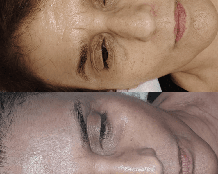 Tratamiento Hifu 25 para rejuvenecimiento facial ( Promo por tiempo limitado )