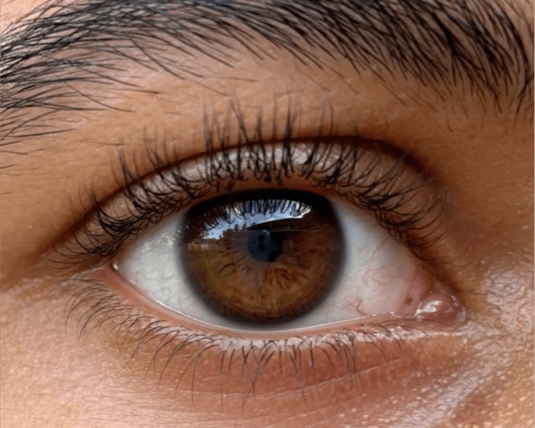 TRATAMIENTO PARA OJERAS