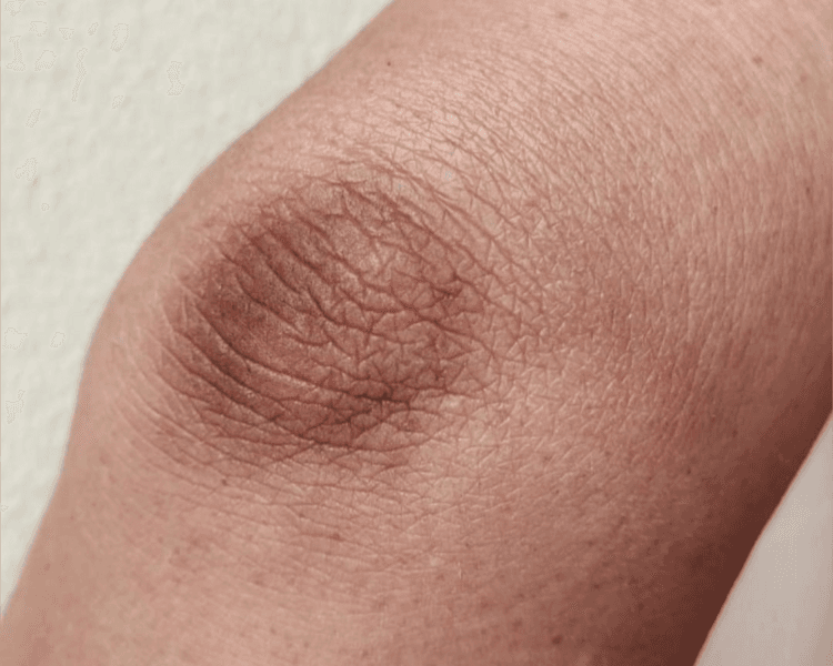 BLANQUEAMIENTO EN CODOS