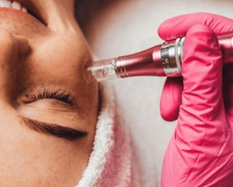 Microneedling Facial (1 sesión)