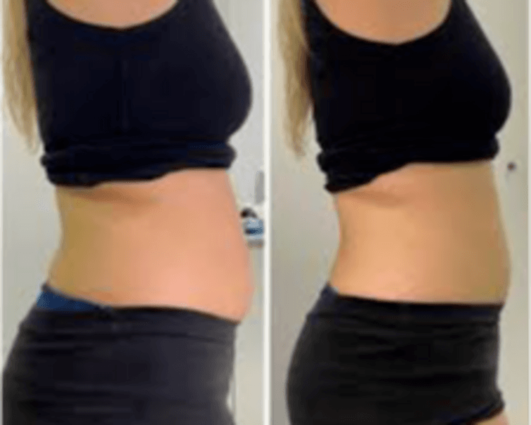 Liposonix corporal 1 zona