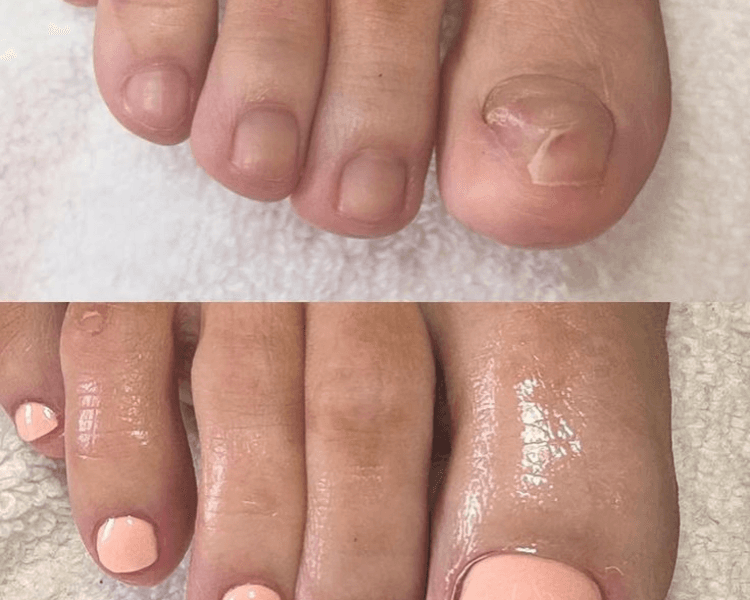 Reconstruccion Uña Del Pie En Acrilico