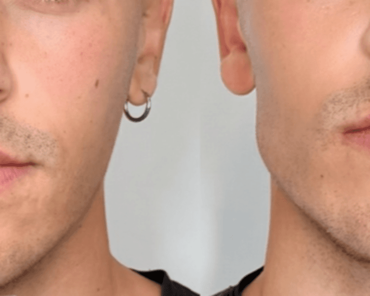 Masculinización (2mL)