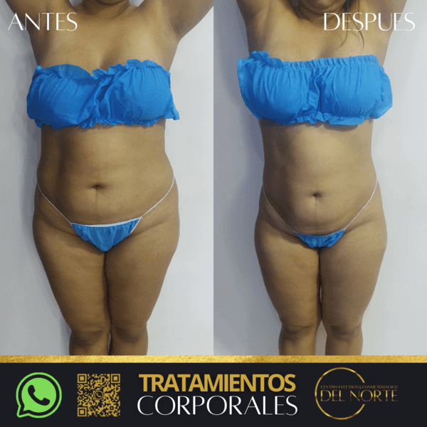 Tratamiento de REDUCCIÓN*10