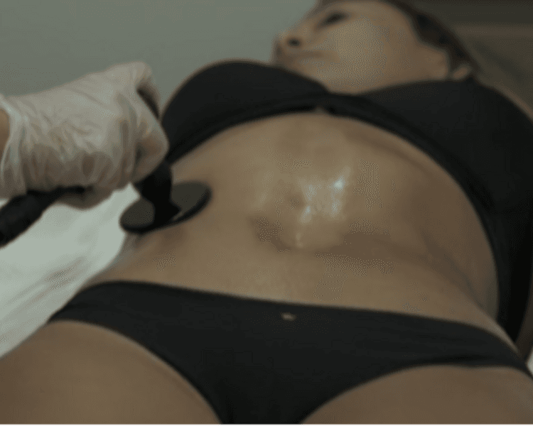 Radiofrecuencia Monopolar – 6 sesiones (1 zona corporal)