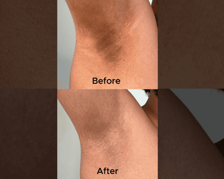 DESPIGMENTACION DE AXILAS PACK X3 SESIONES