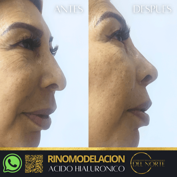Ácido Hialuronico RINOMODELACION