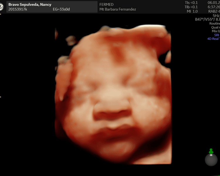 Ecografía 5D