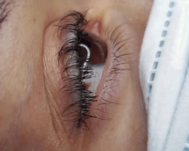 Reversión de lifting de pestañas