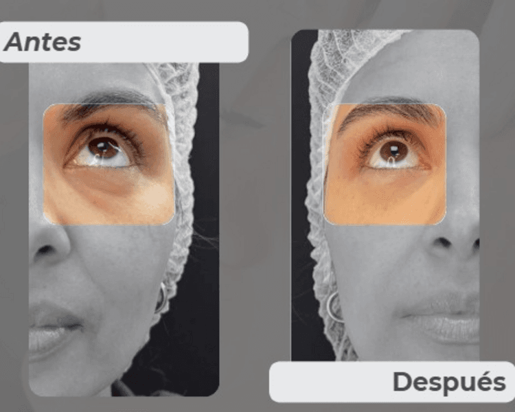 Ácido Hialurónico Ojeras