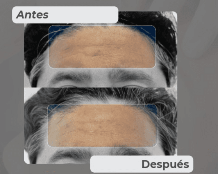 Ácido Hialurónico Arrugas Finas (Peribucal, mejillas, frente o surco)