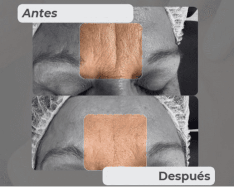 Ácido Hialurónico Arrugas Finas (Entrecejo, Marioneta, Patas de gallo)