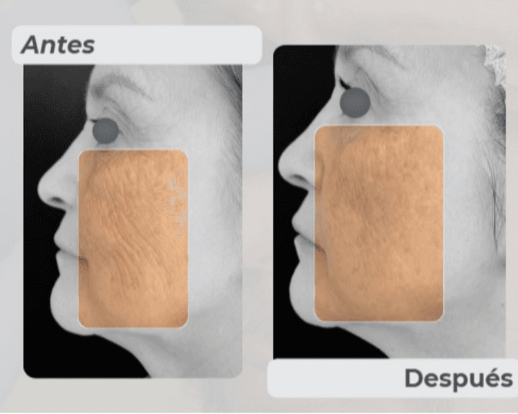 HydroxyFill - 2 sesiones