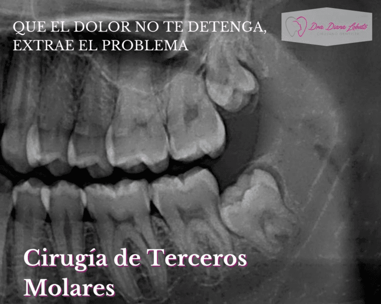 Cirugía de 3eros Molares