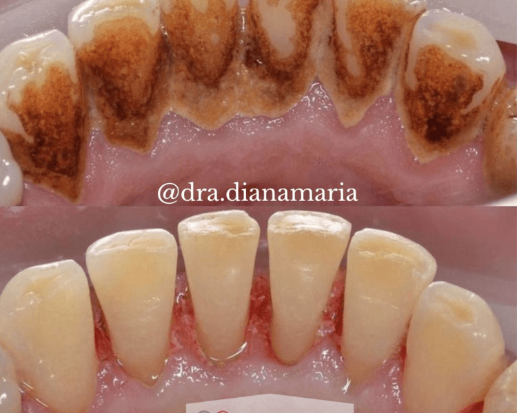 Limpieza Dental Profunda