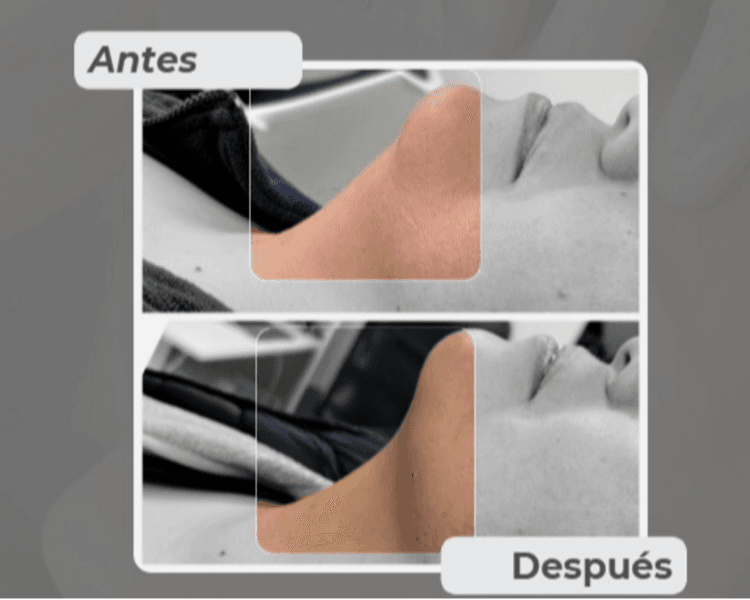 Lipolítico - Papada