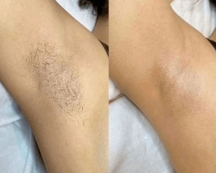 Depilación láser cuerpo completo (8 sesiones)