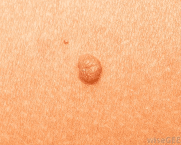 Valoración remoción de lunares