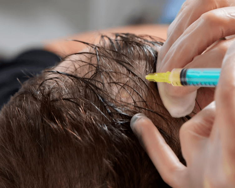 TERAPIA PLASMA RICO EN PLAQUETAS BIOESTIMULACIÓN CAPILAR