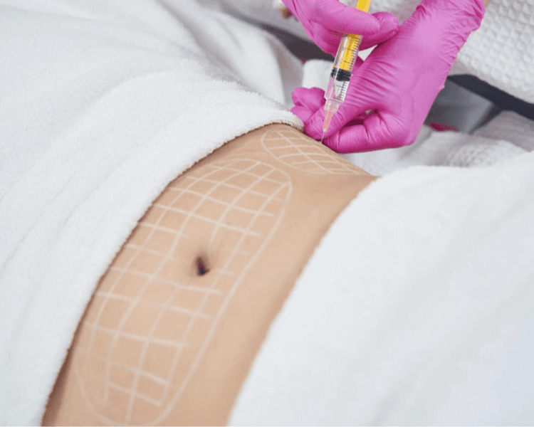 Mesoterapia Corporal - Zona abdominal