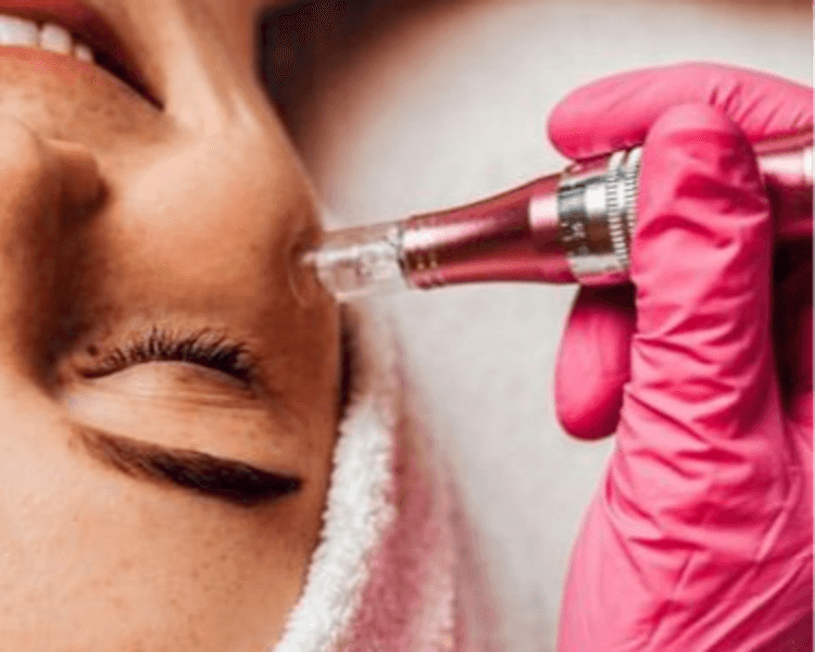 💉 Limpieza Facial con Dermapen (según vitamina)
