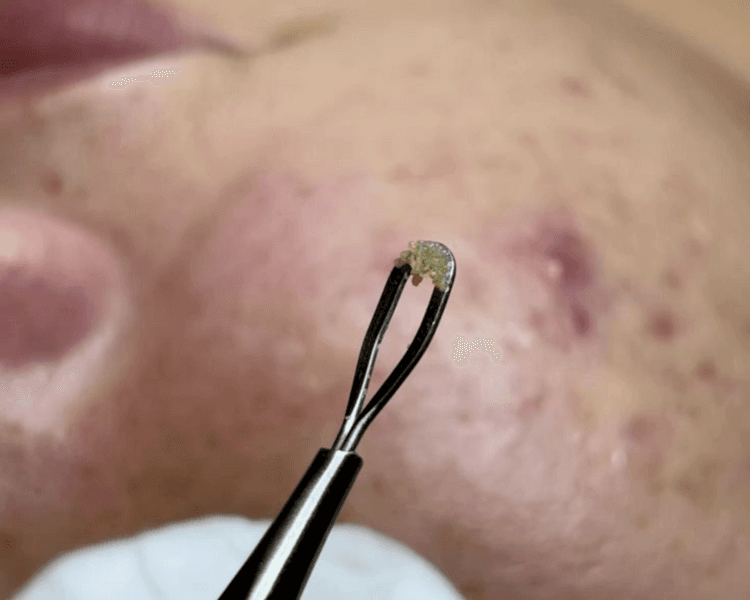 🌿 Tratamiento de Acné(4 sesiones) segun valoración