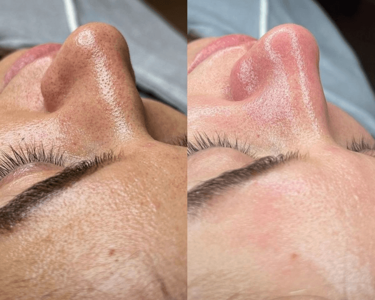 LUMIGLOW (peeling para luminosidad e hidratación facial)