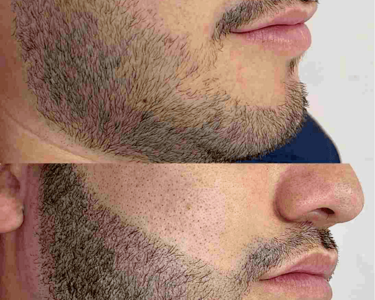 Micropigmentación Efecto Barba