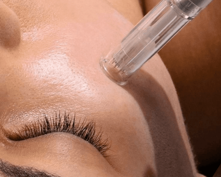 Limpieza con Dermapen