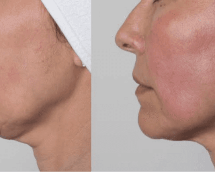 Masaje facial efecto lifting